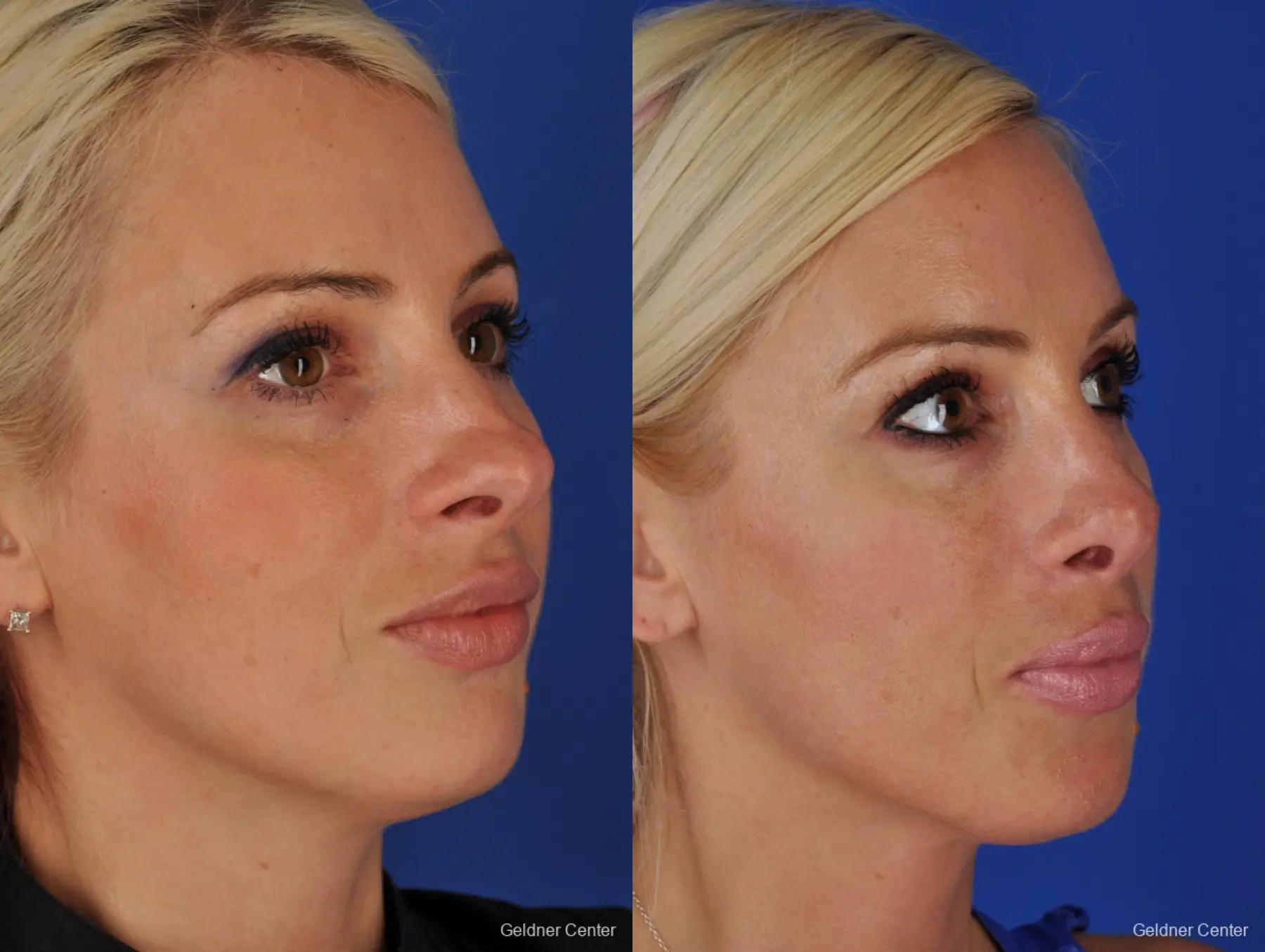 Chicago Rhinoplasty - Before and After 3