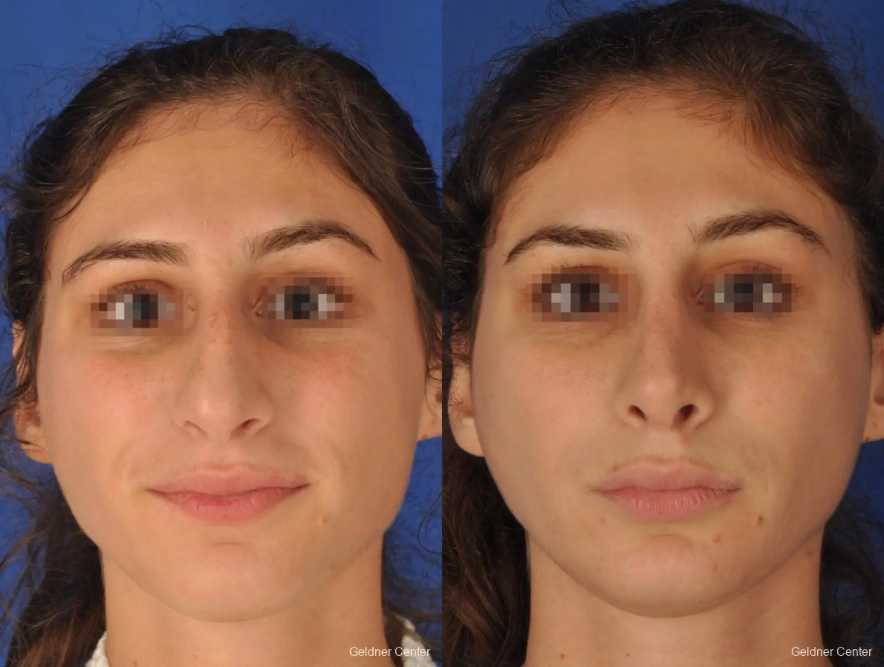 Rhinoplasty: Patient 4 - Before and After  