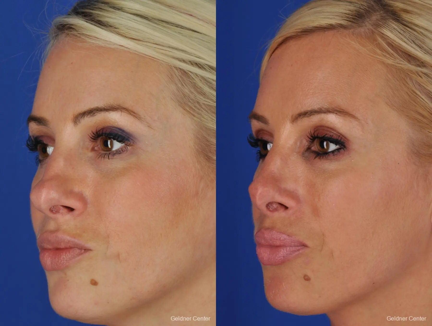 Chicago Rhinoplasty - Before and After 4