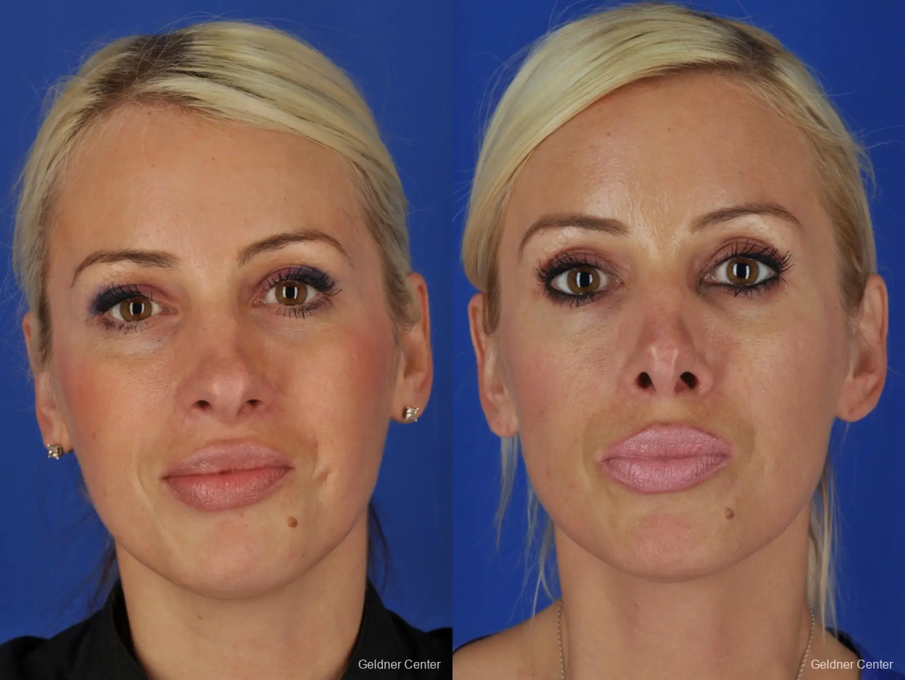 Chicago Rhinoplasty - Before and After 1