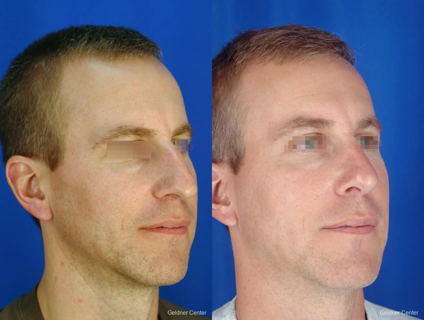 Rhinoplasty For Men: Patient 1 - Before and After 2