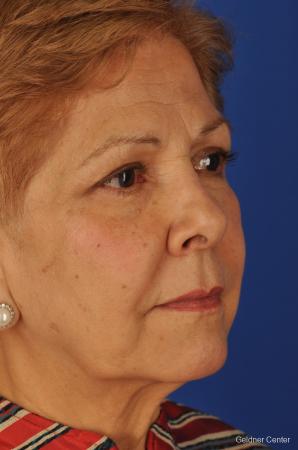 Neck Lift: Patient 1 - Before Image 3