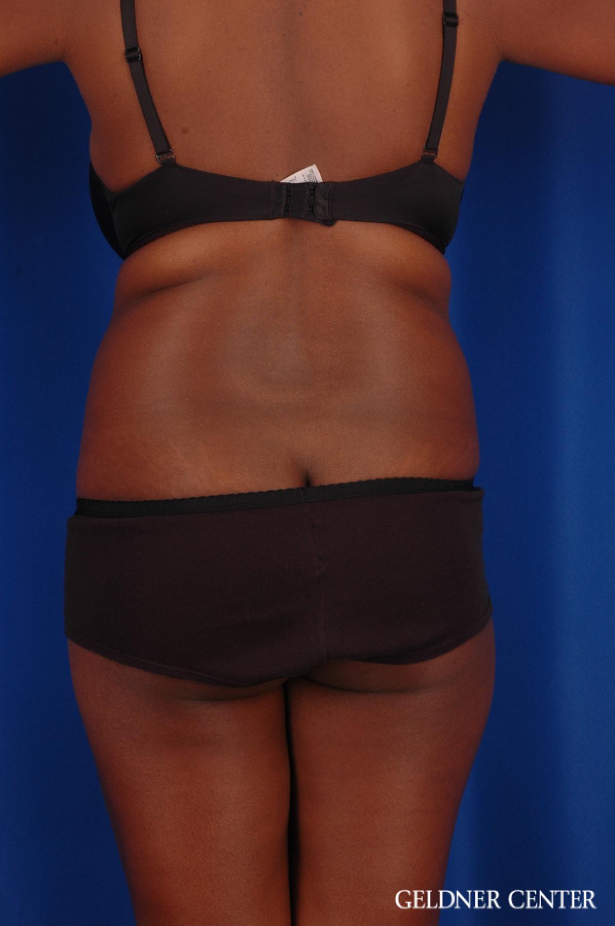 Liposuction: Patient 42 - Before 4