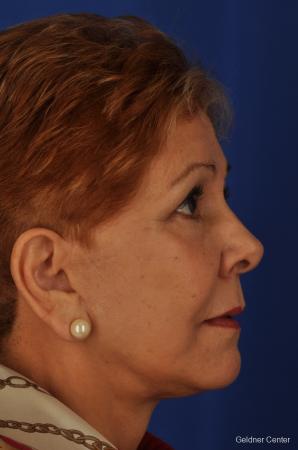Neck Lift: Patient 1 - After Image 2
