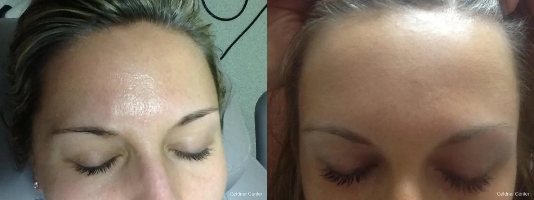 SkinPen®: Patient 9 - Before and After 1