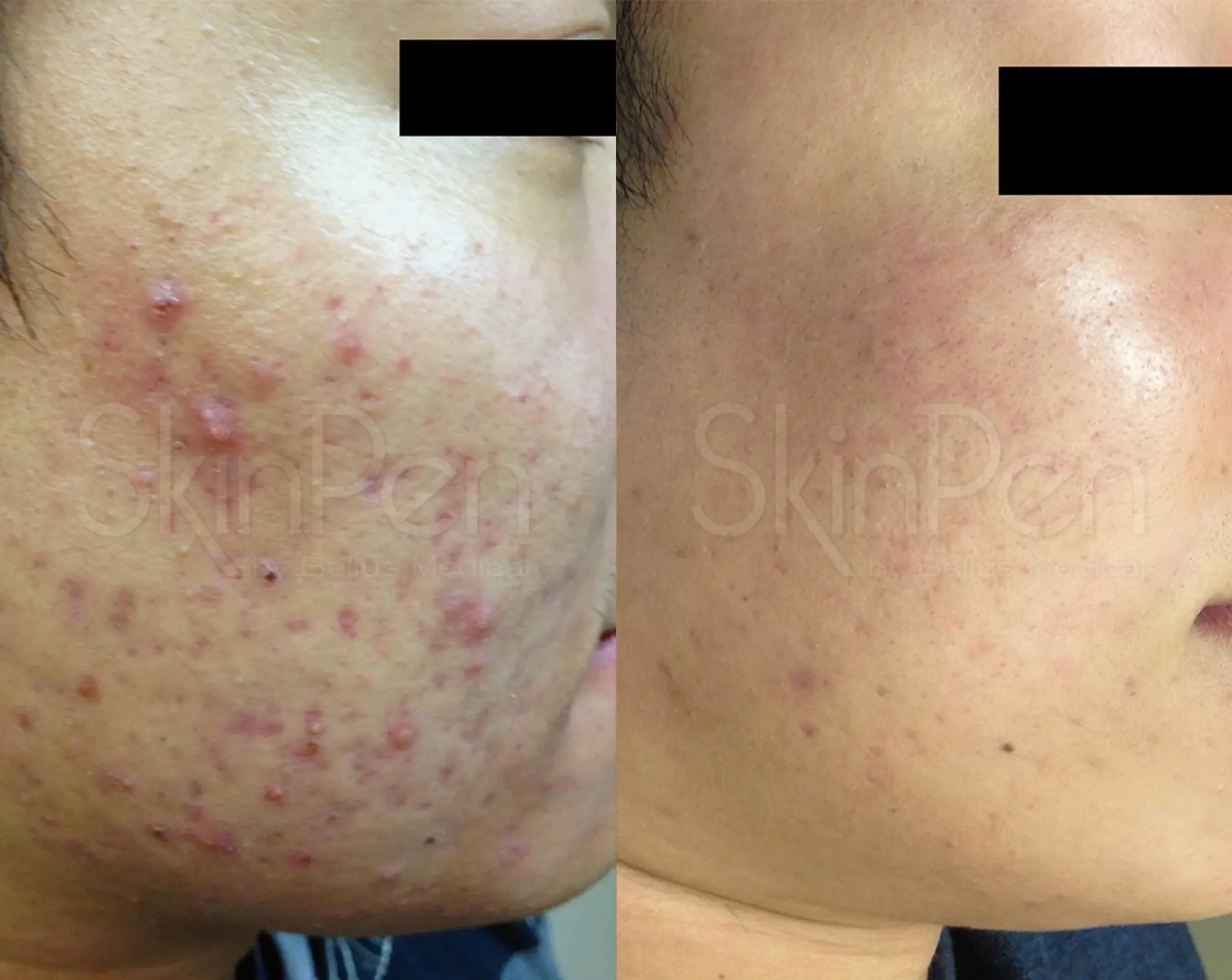 Skinpen-for-men: Patient 3 - Before and After  