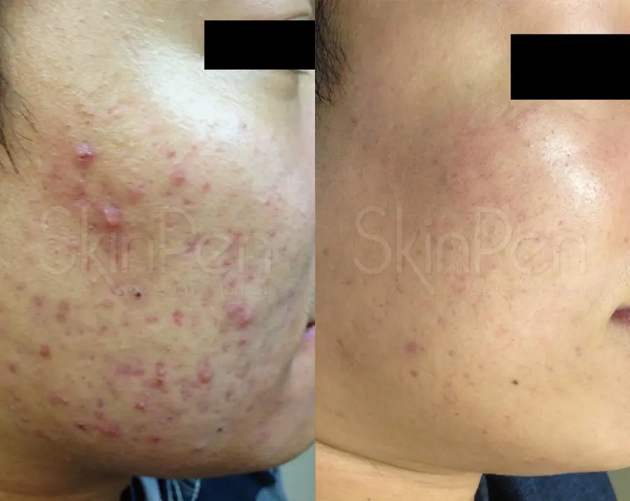 Skinpen-for-men: Patient 1 - Before and After  