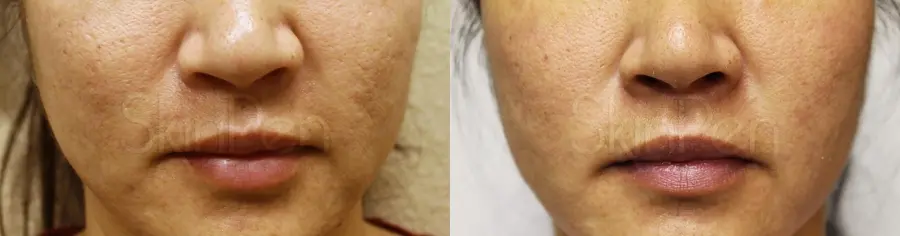 SkinPen®: Patient 5 - Before and After 1