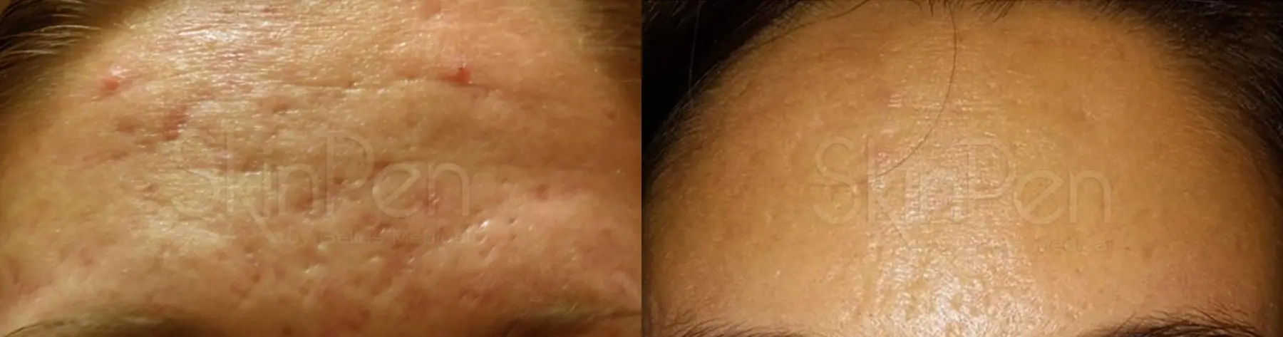 SkinPen®: Patient 11 - Before and After  