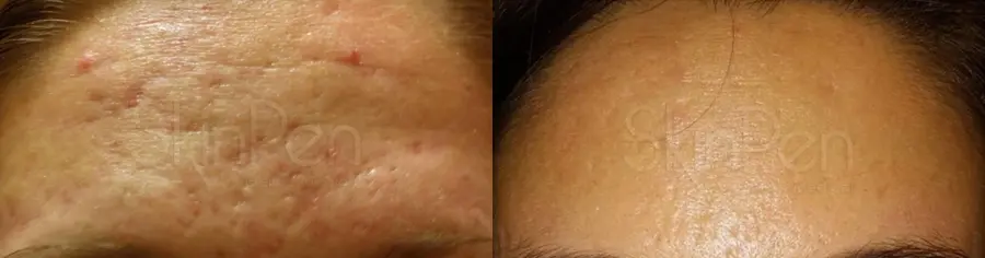 SkinPen®: Patient 4 - Before and After 1