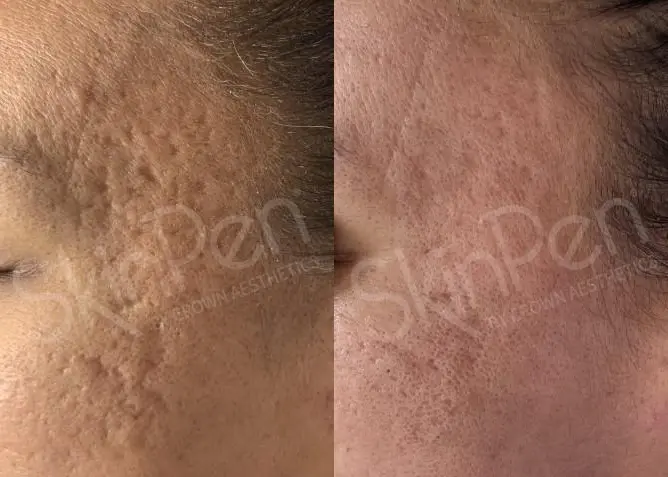 SkinPen®: Patient 5 - Before and After 1
