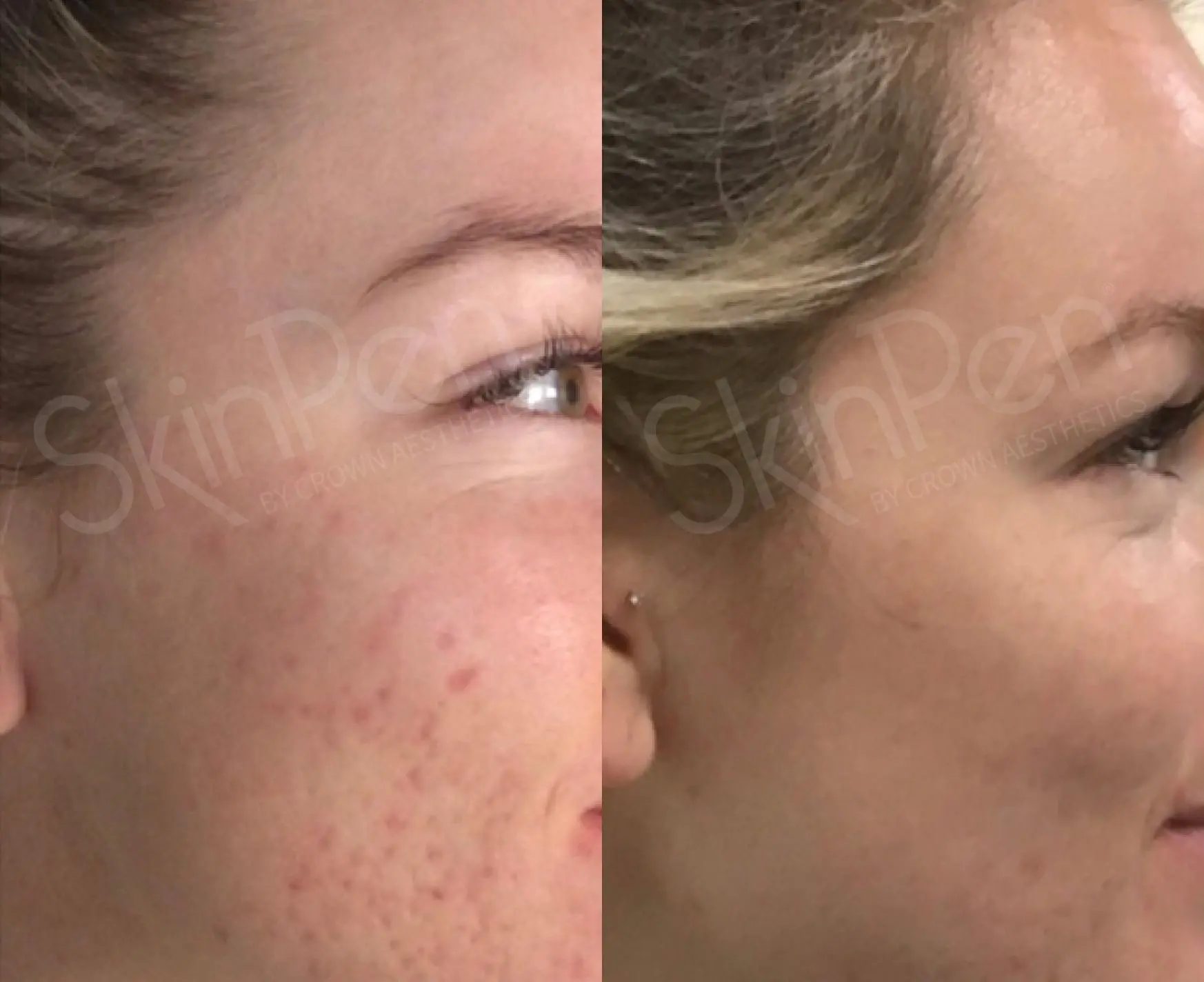 SkinPen®: Patient 3 - Before and After  