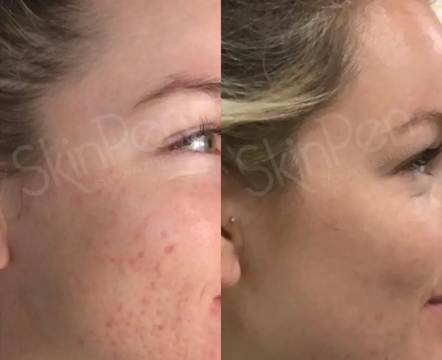 SkinPen®: Patient 7 - Before and After 1