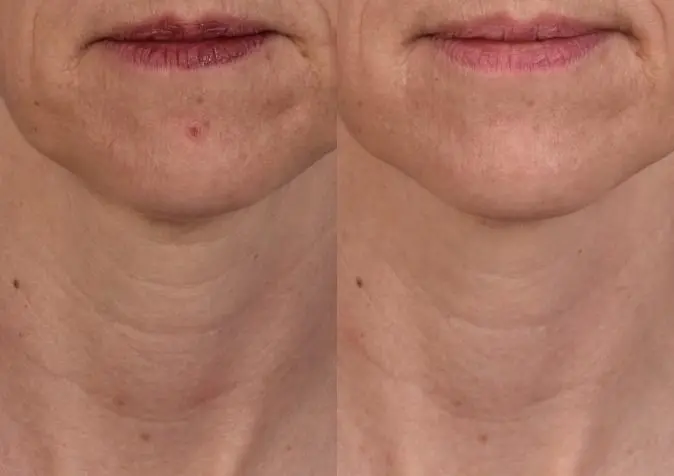 SkinPen®: Patient 11 - Before and After 1