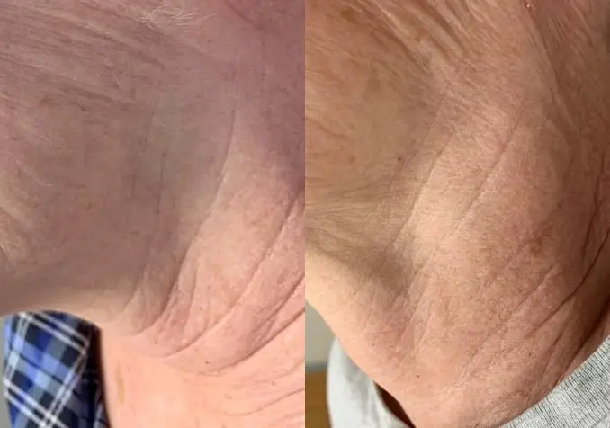 SkinPen®: Patient 4 - Before and After 1