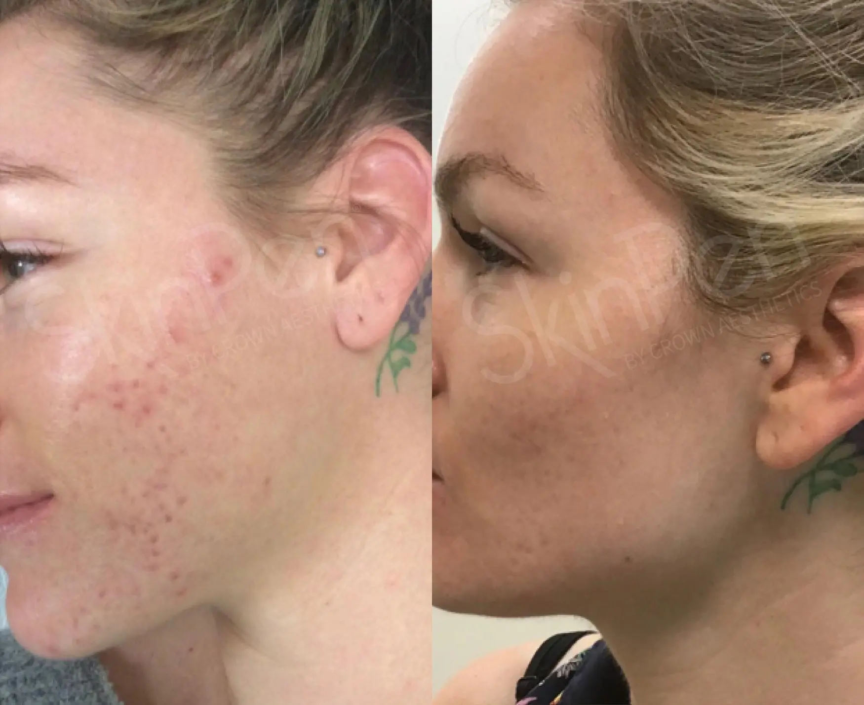 SkinPen®: Patient 1 - Before and After 1