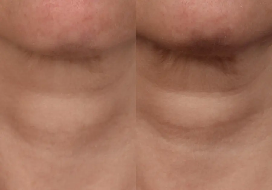 SkinPen®: Patient 6 - Before and After  
