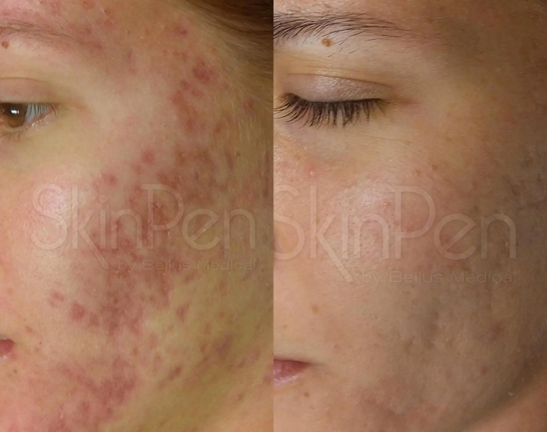SkinPen®: Patient 2 - Before and After 1