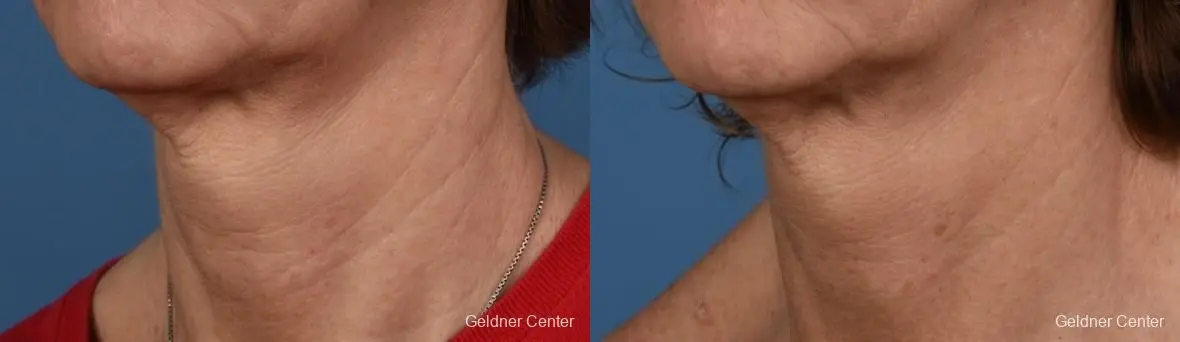 SkinPen®: Patient 10 - Before and After  