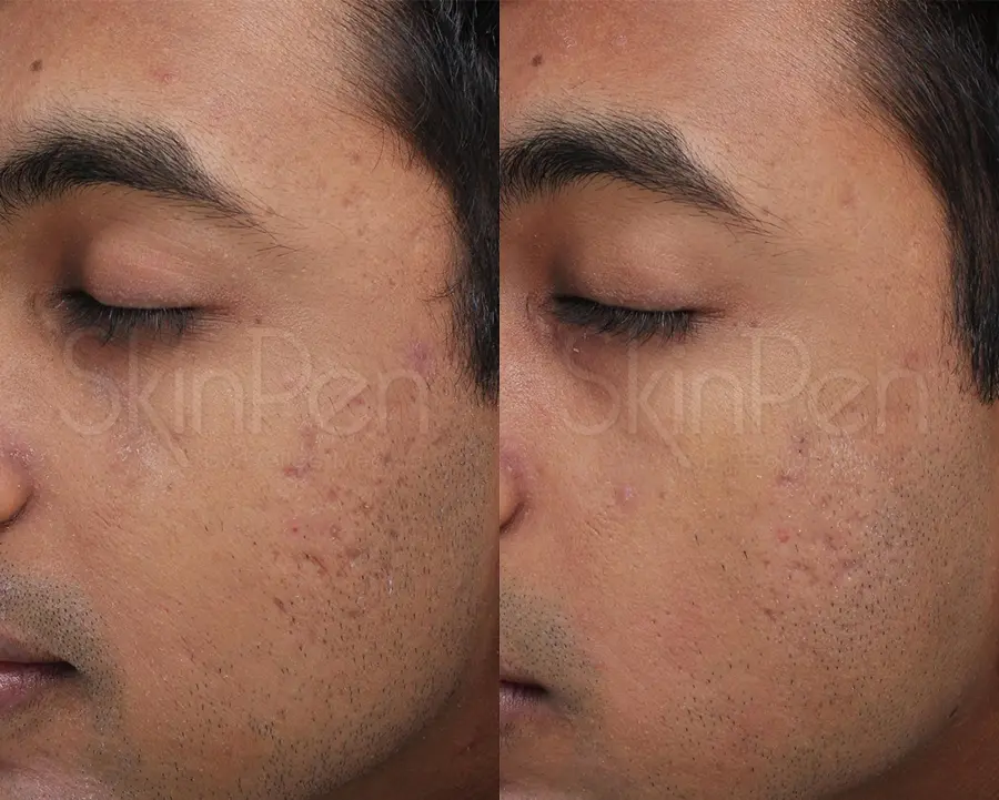 Skinpen For Men: Patient 3 - Before and After 1