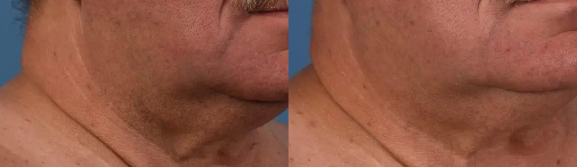 Skinpen-for-men: Patient 4 - Before and After  
