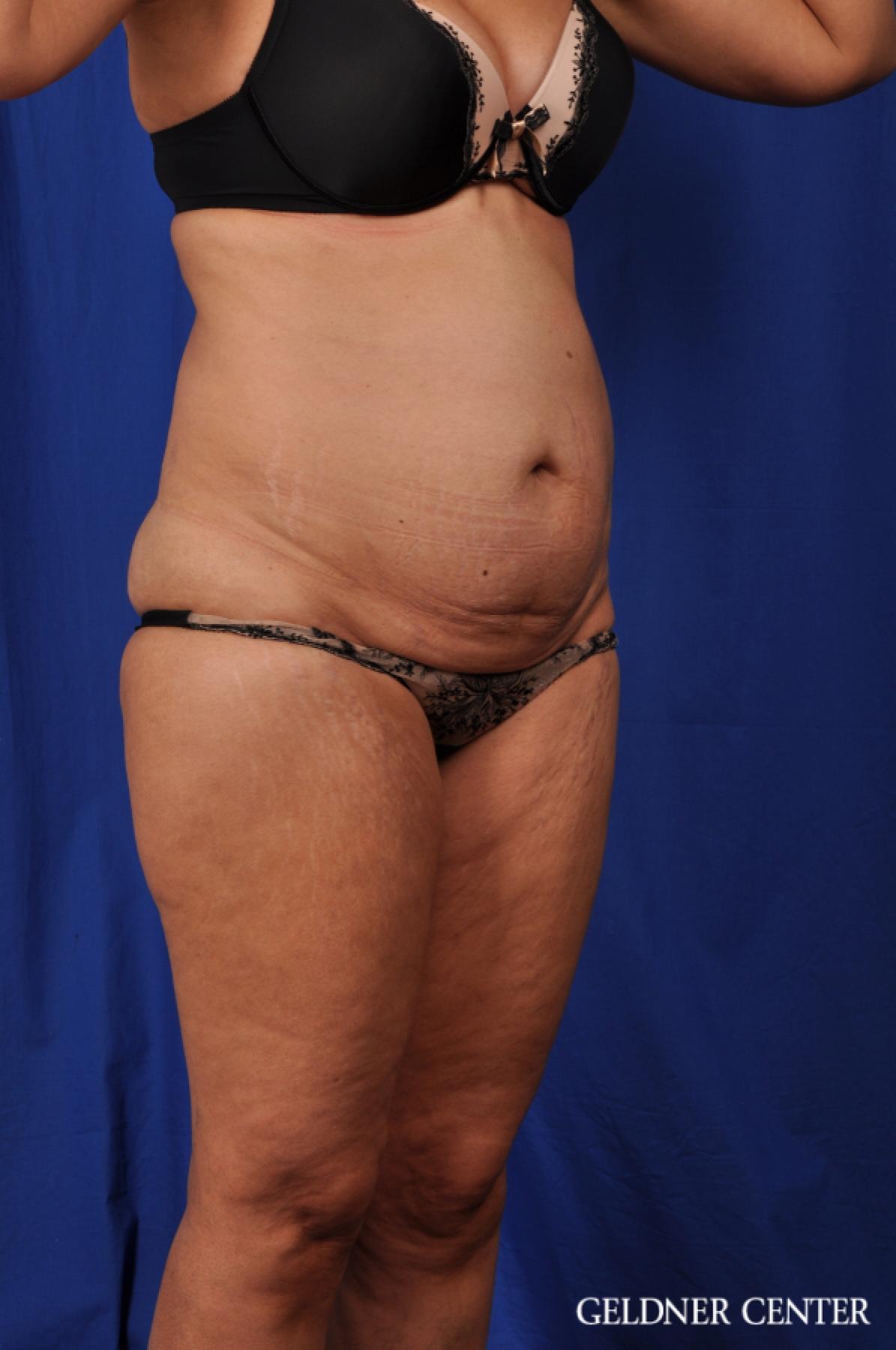 Tummy Tuck: Patient 21 - Before 2