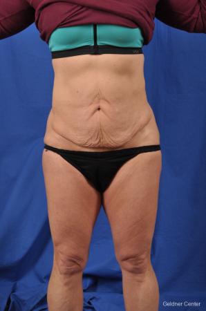 Abdominoplasty: Patient 7 - Before Image 1
