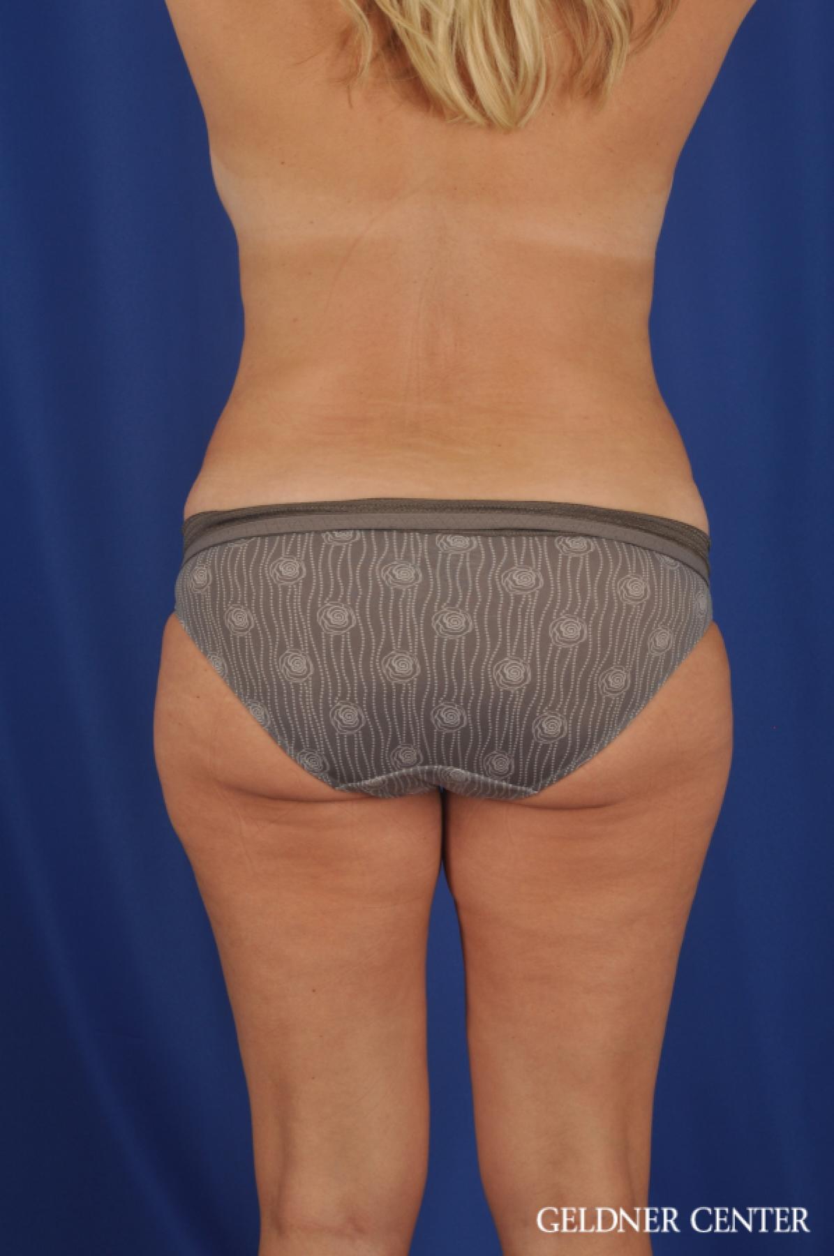 Tummy Tuck: Patient 23 - After 4