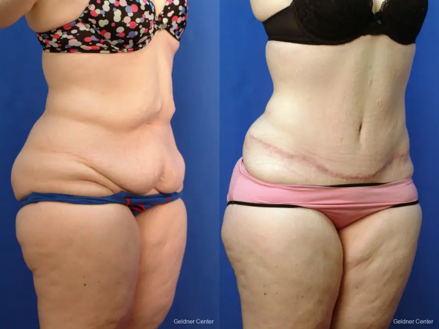 Tummy Tuck: Patient 10 - Before and After 2