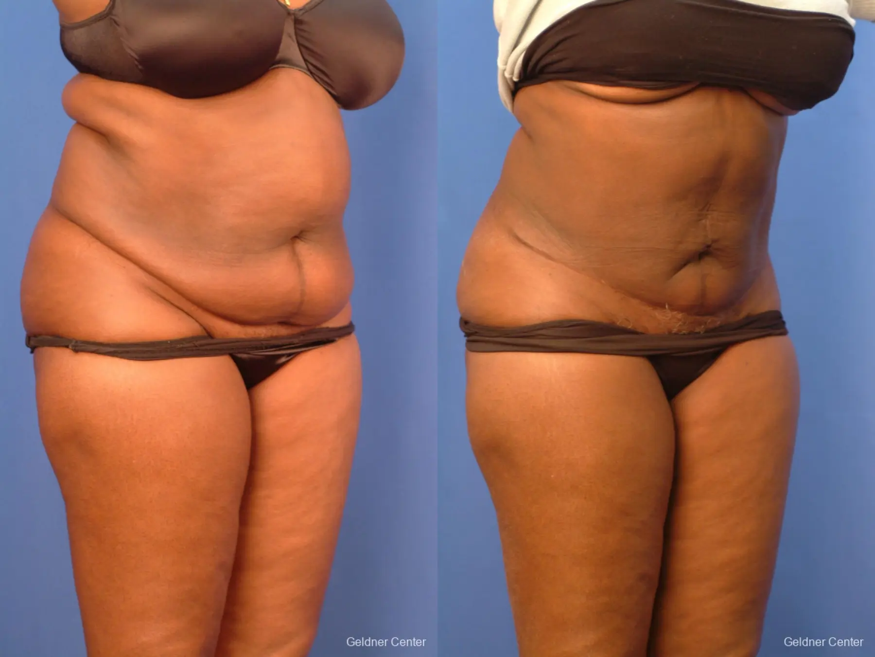 Tummy Tuck: Patient 14 - Before and After 3