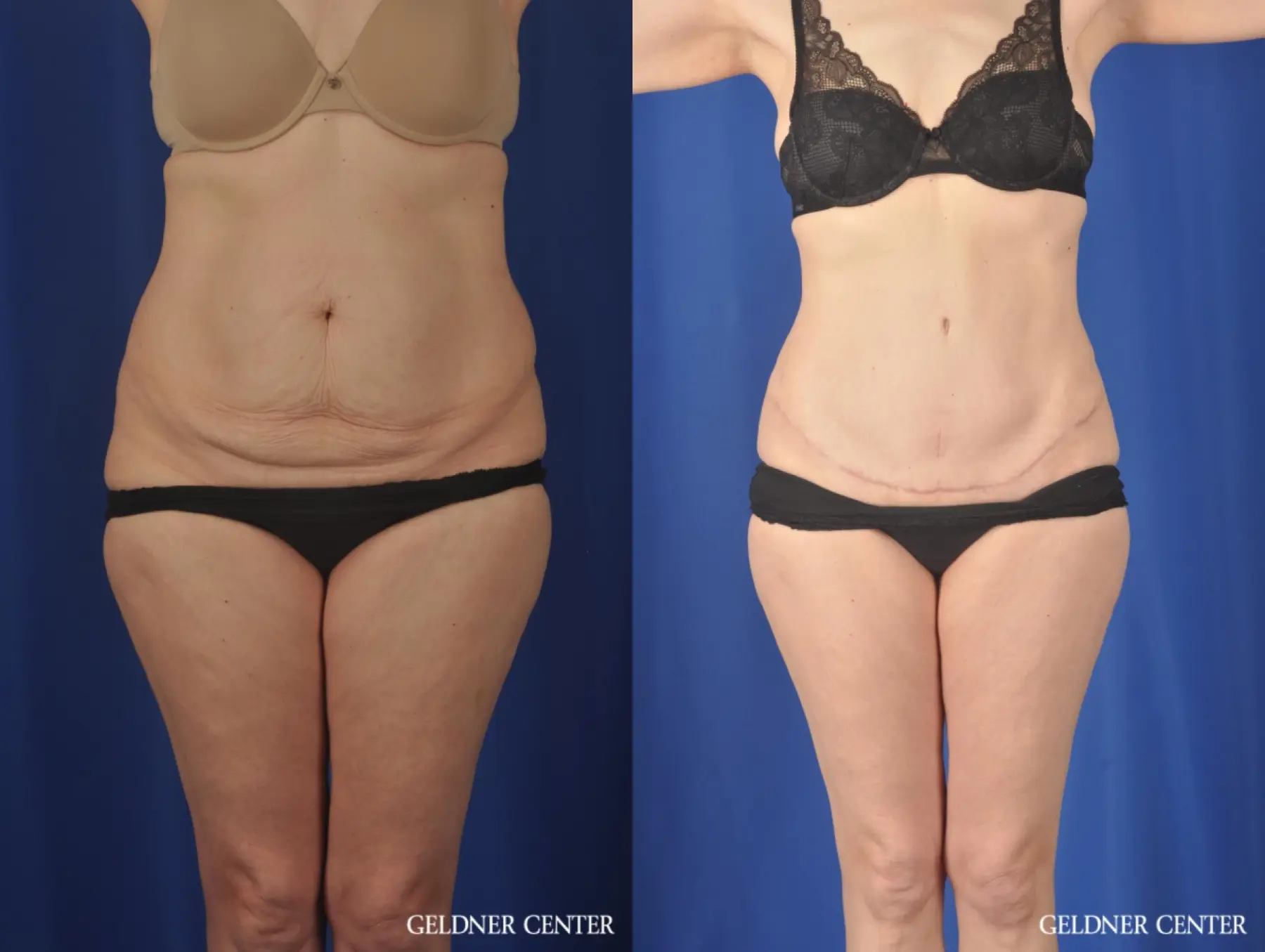 Chicago Abdominoplasty 11851 - Before and After