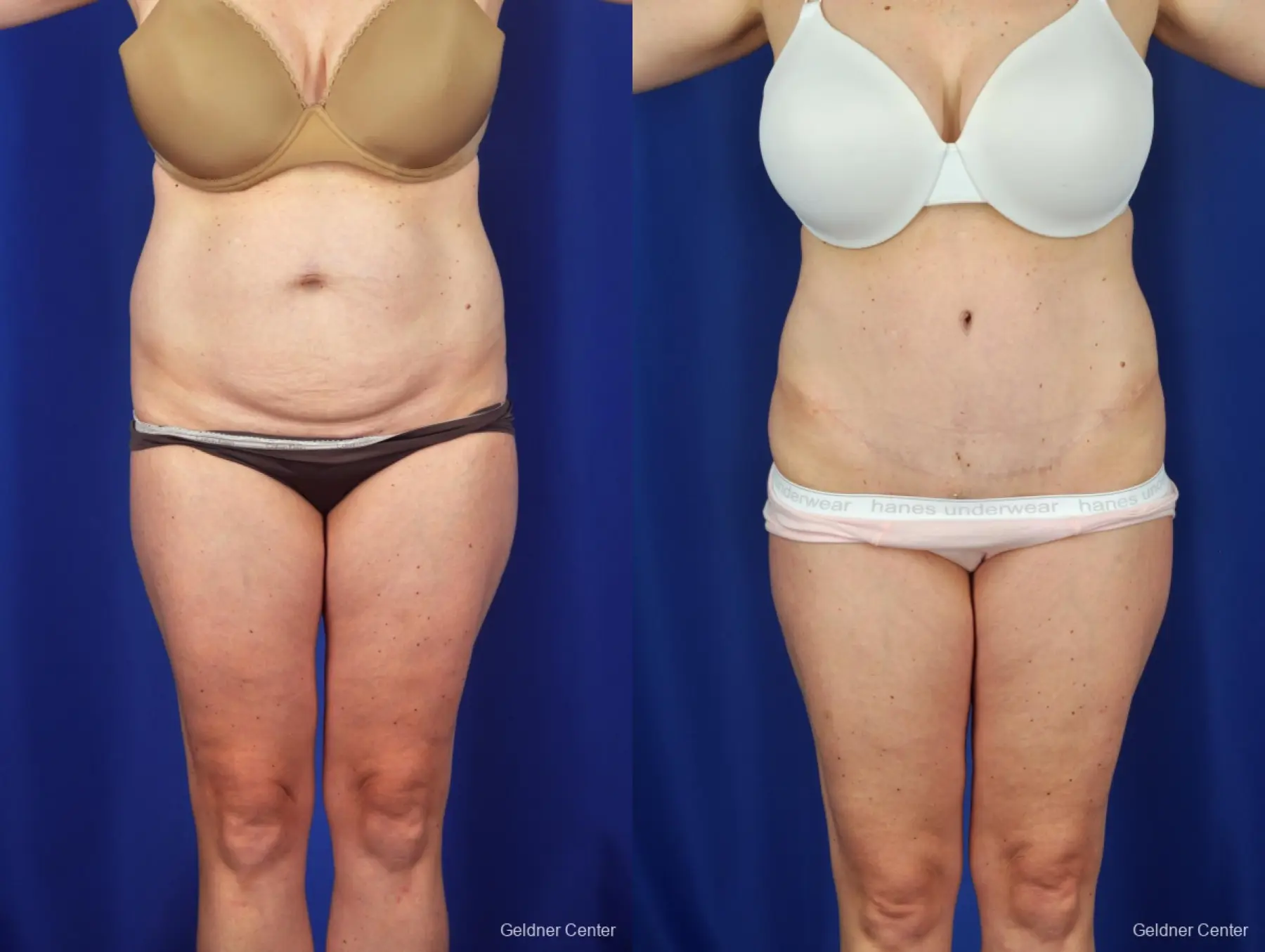 Abdominoplasty Tummy Tuck Patient 2384 - Before and After