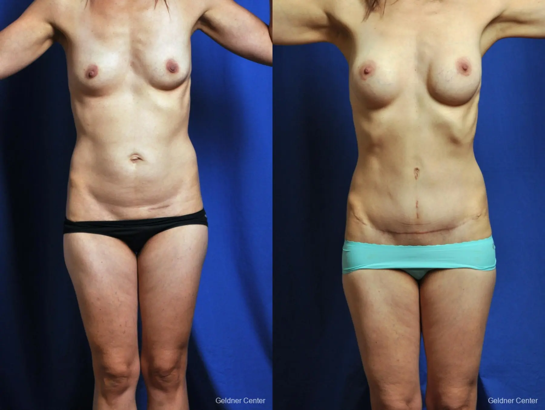Abdominoplasty Tummy Tuck Patient 2378 - Before and After
