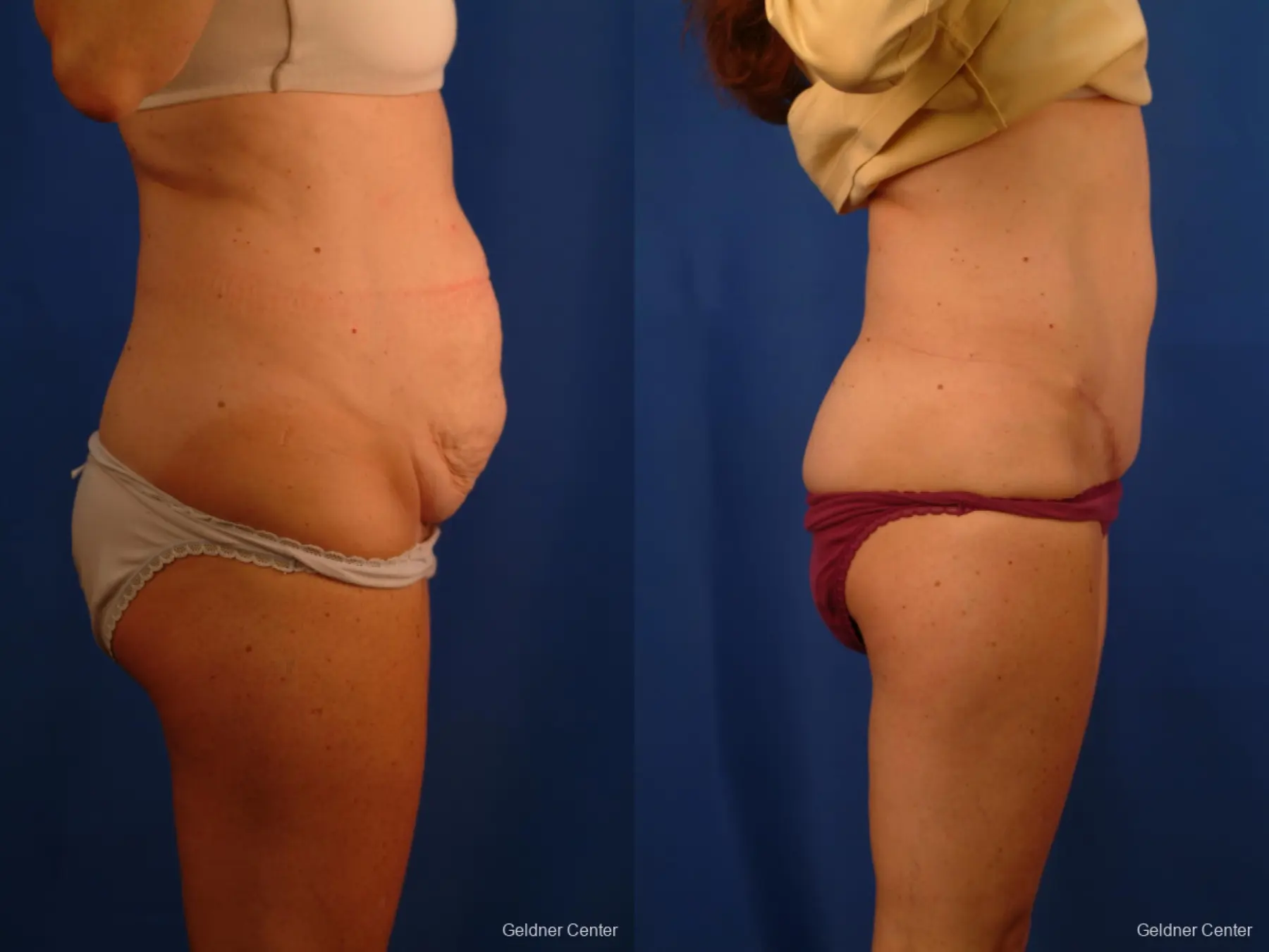 Tummy Tuck: Patient 12 - Before and After 3
