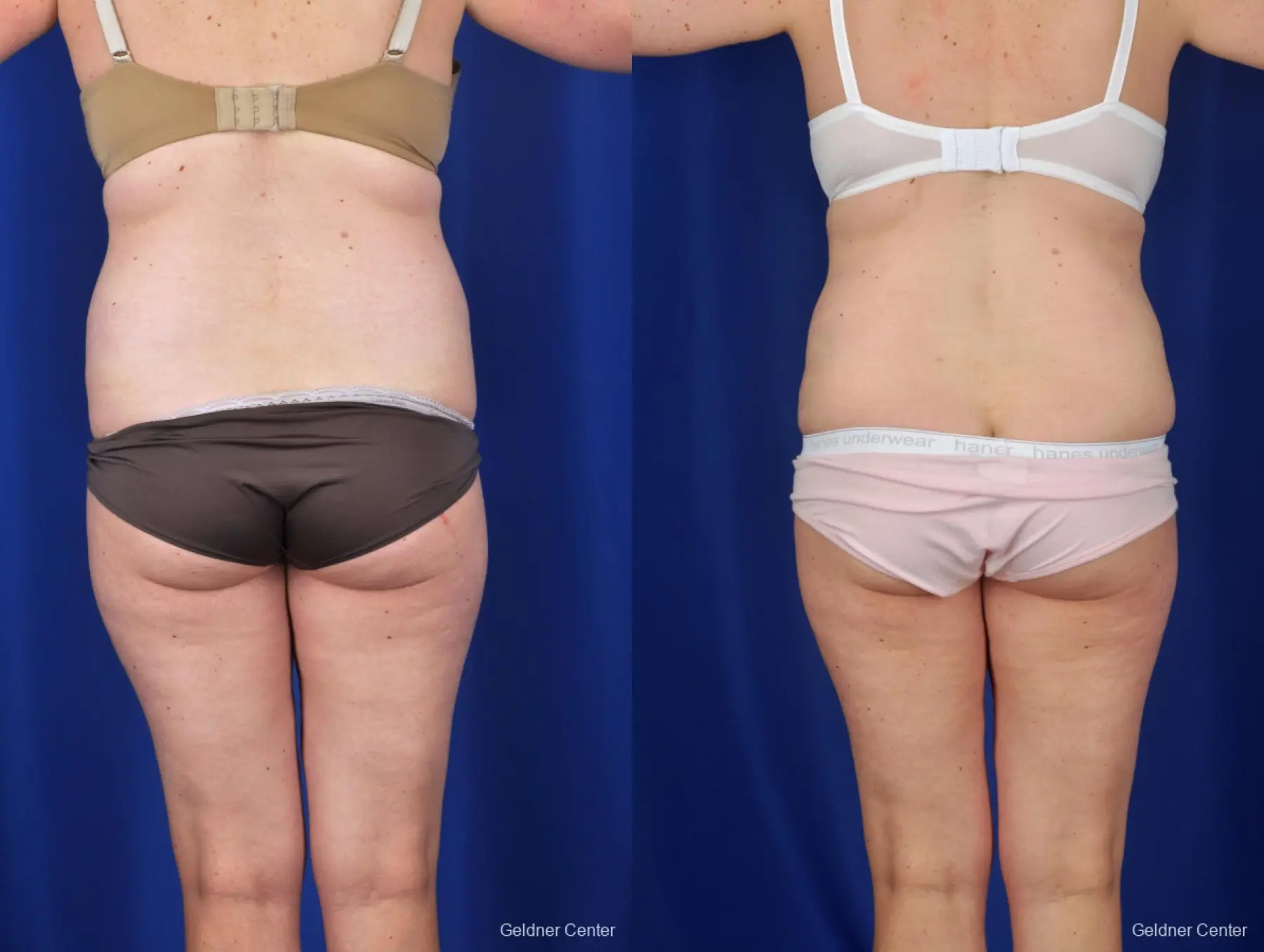 Tummy Tuck: Patient 7 - Before and After 4