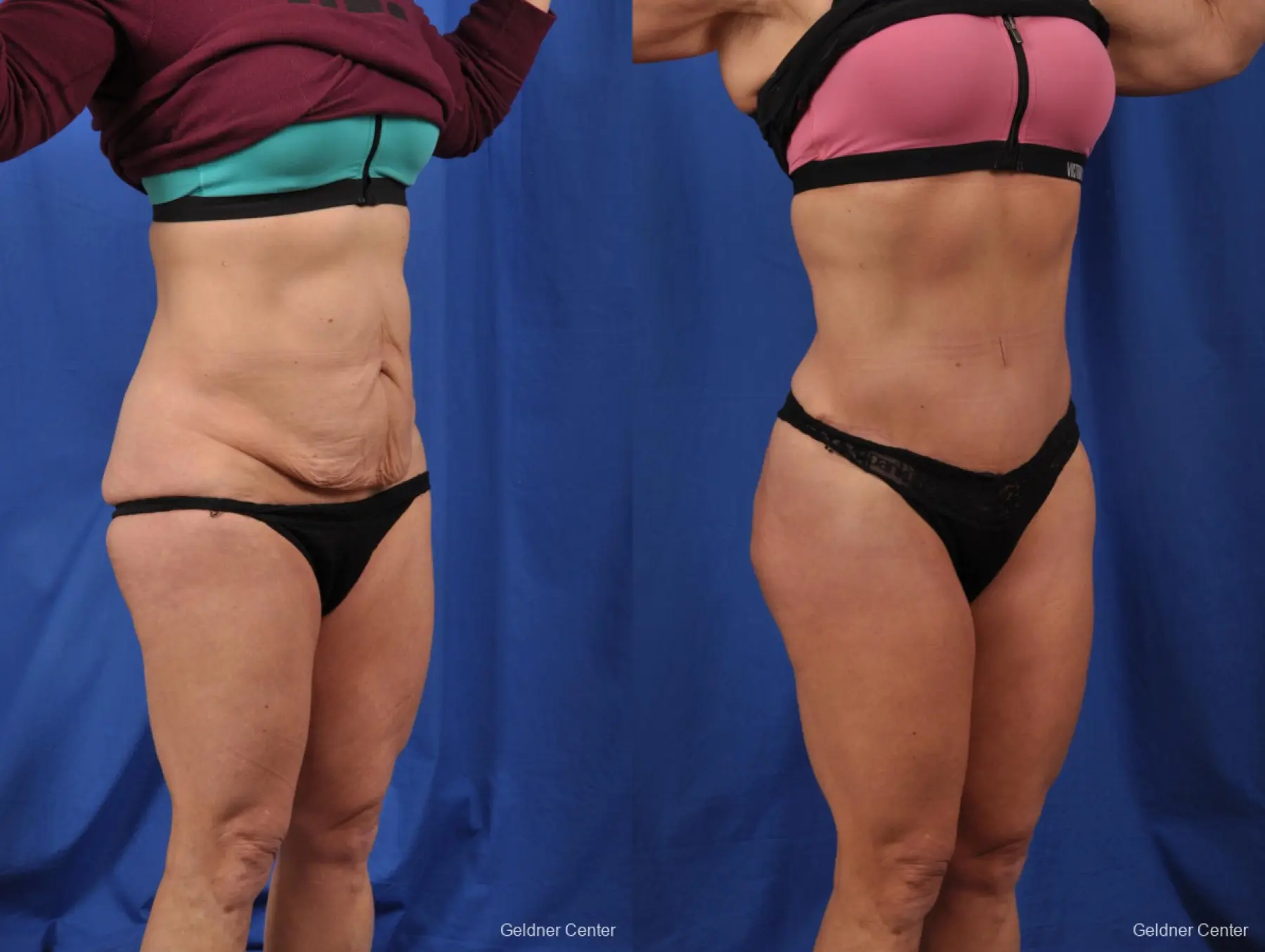 Tummy Tuck: Patient 31 - Before and After 2