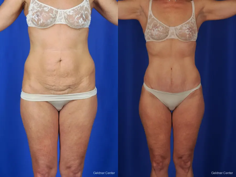 Tummy Tuck: Patient 2 - Before and After  