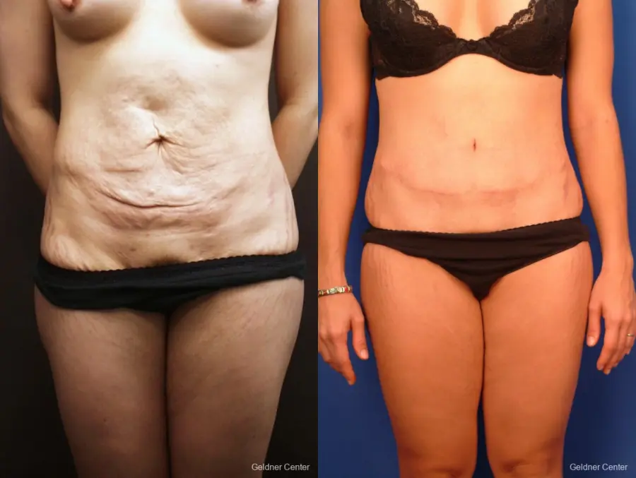 Tummy Tuck: Patient 11 - Before and After 1