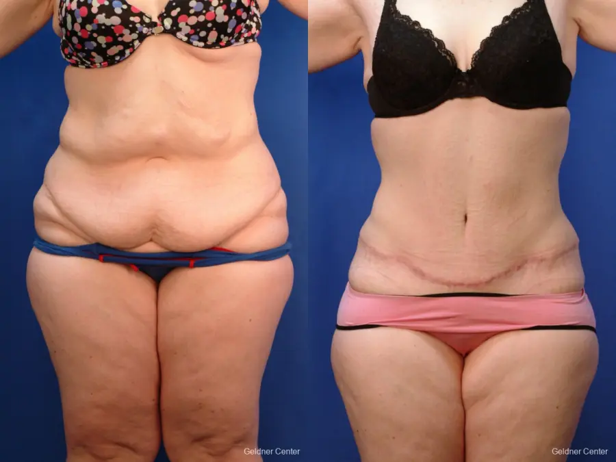 Tummy Tuck: Patient 10 - Before and After 1