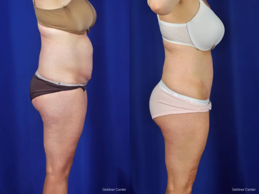 Tummy Tuck: Patient 7 - Before and After 3