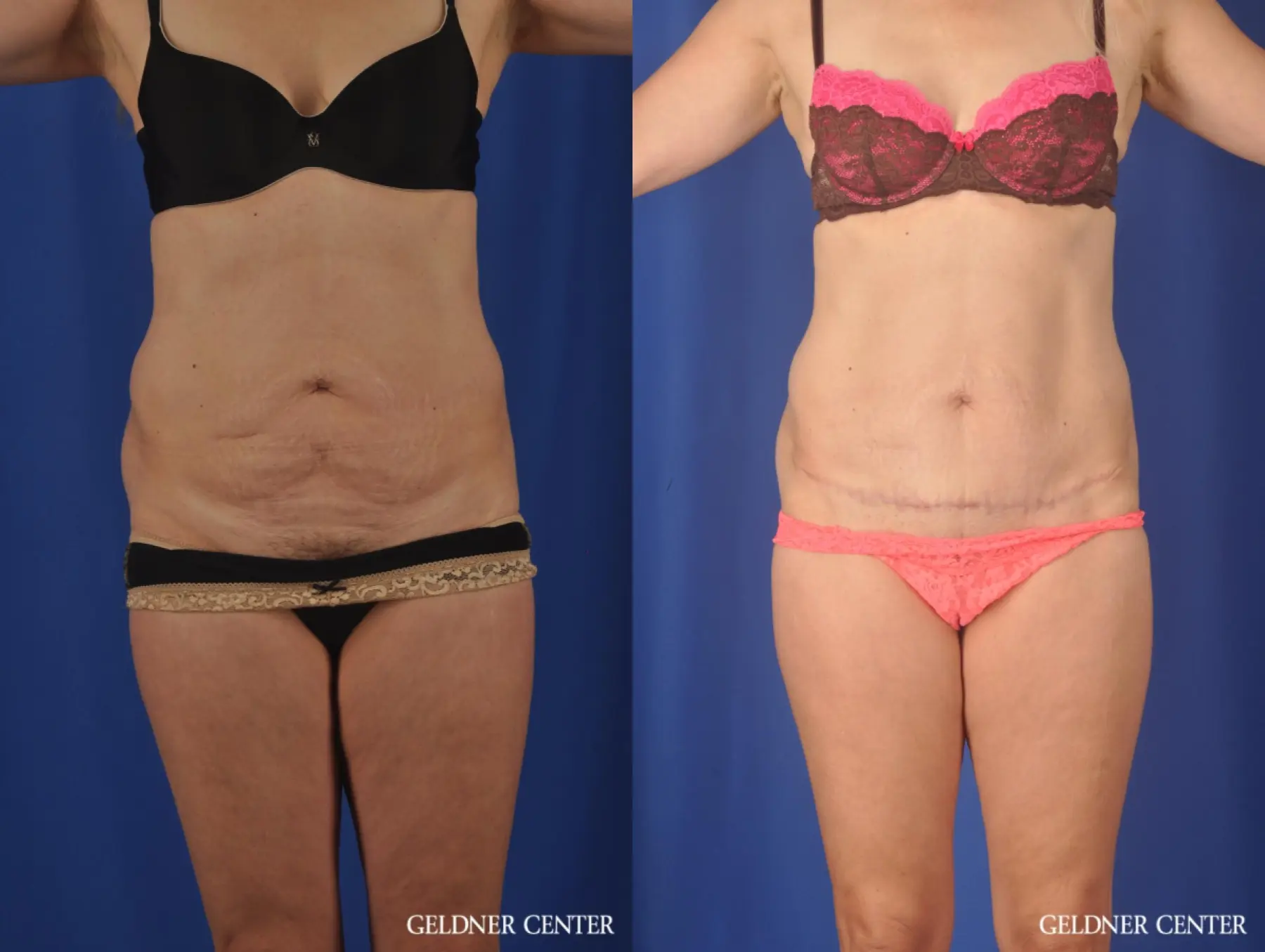 Chicago Abdominoplasty 11854 - Before and After
