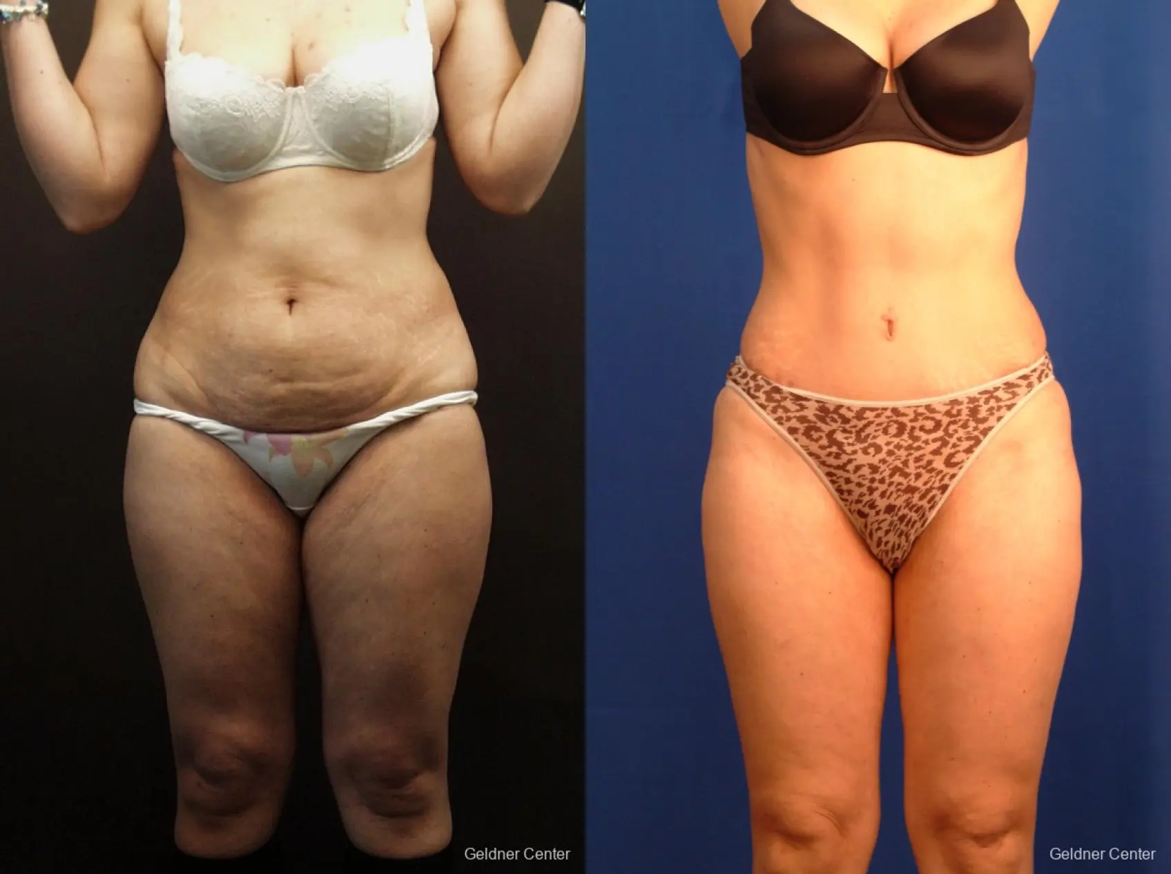 Abdominoplasty Tummy Tuck Patient 2408 - Before and After