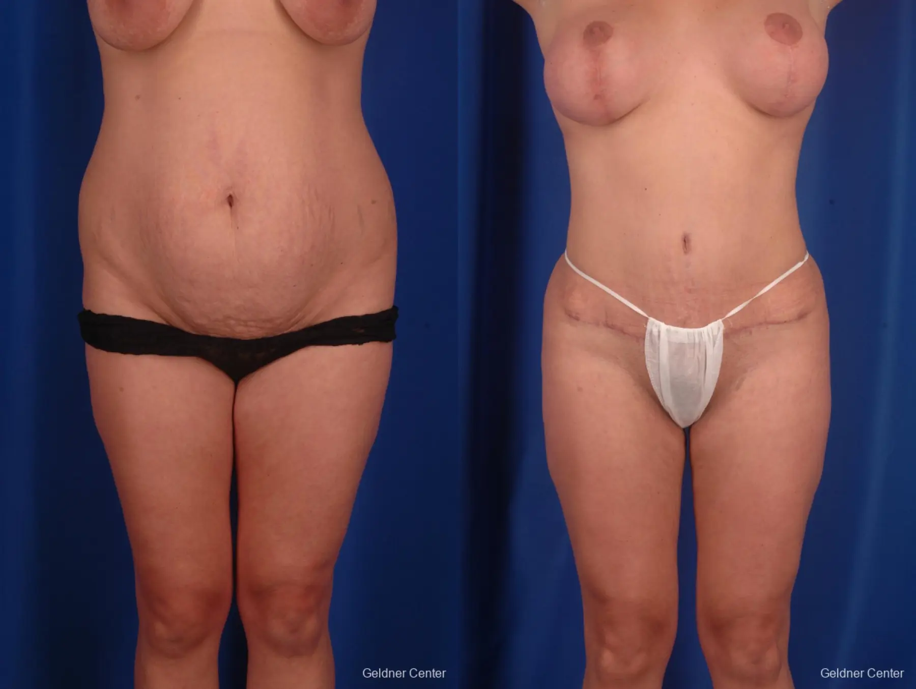 Abdominoplasty Tummy Tuck Patient 2303 - Before and After