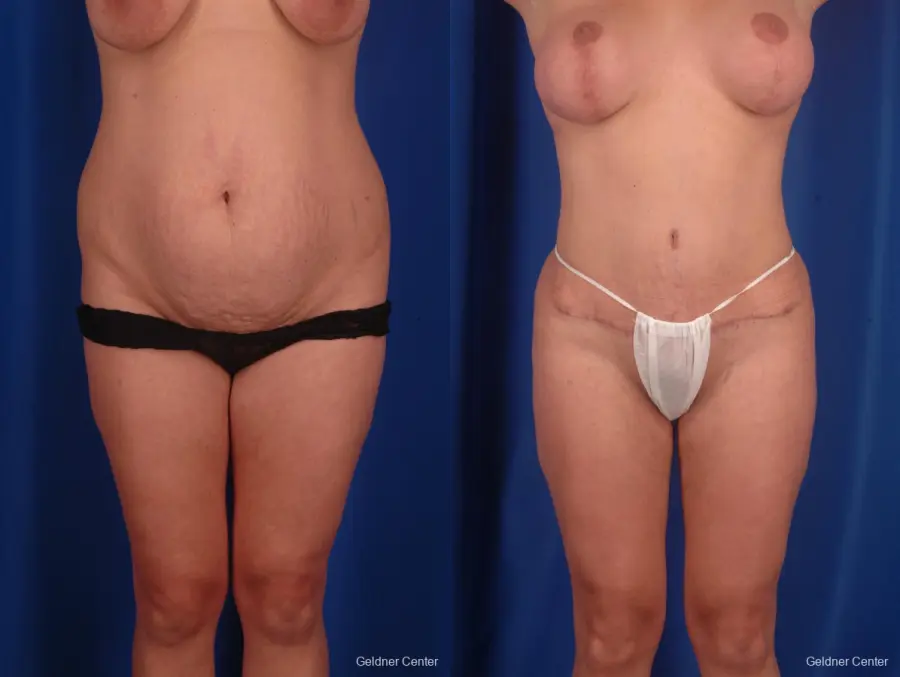 Tummy Tuck: Patient 3 - Before and After  