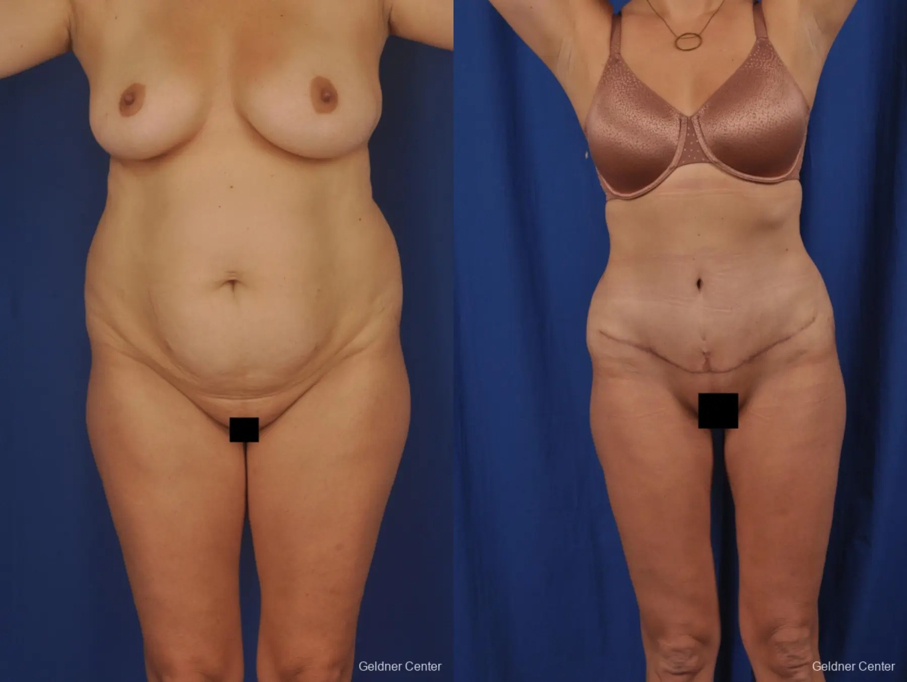 Abdominoplasty with Vaser Liposuction - Before and After