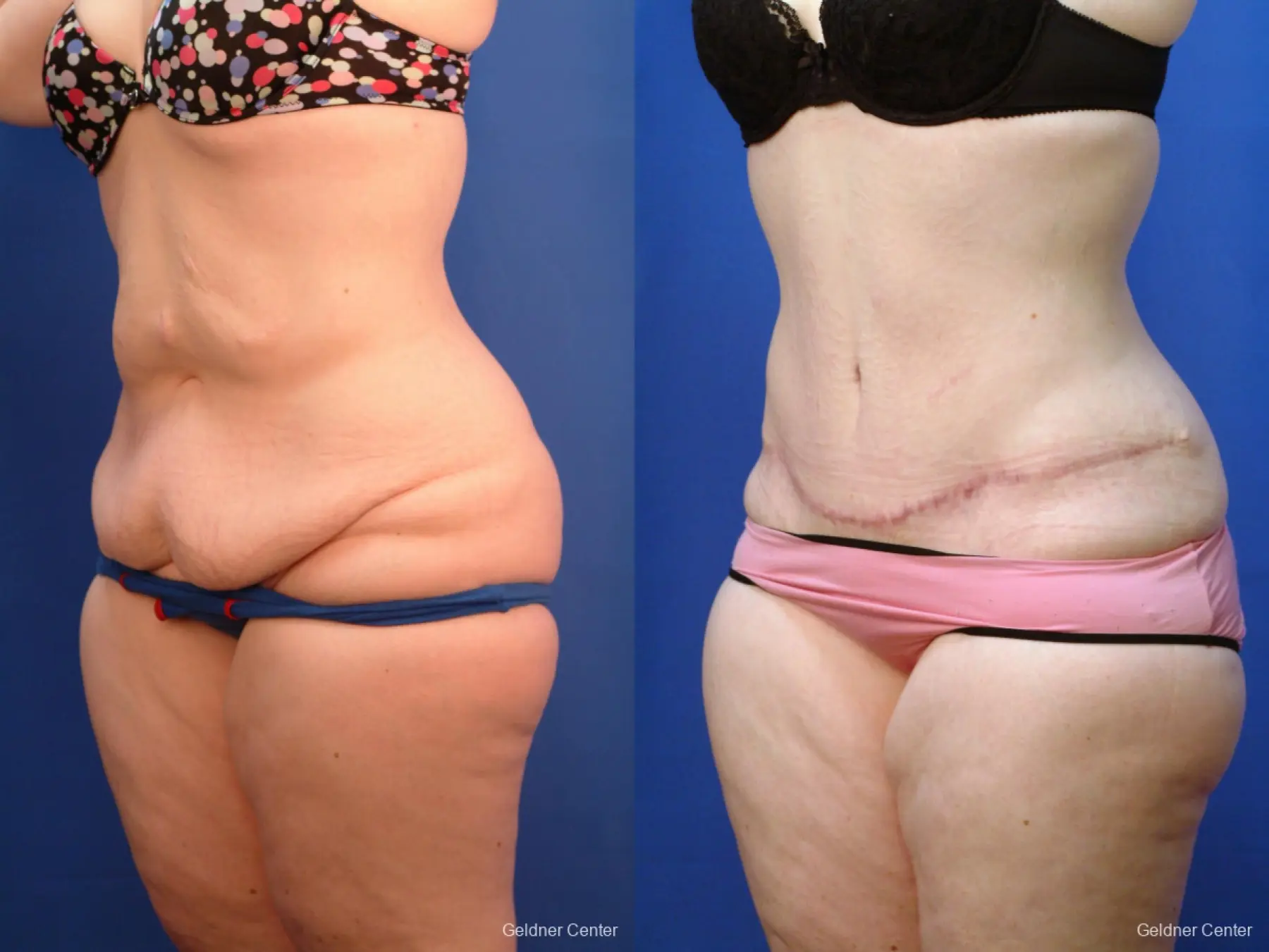 Tummy Tuck: Patient 10 - Before and After 3