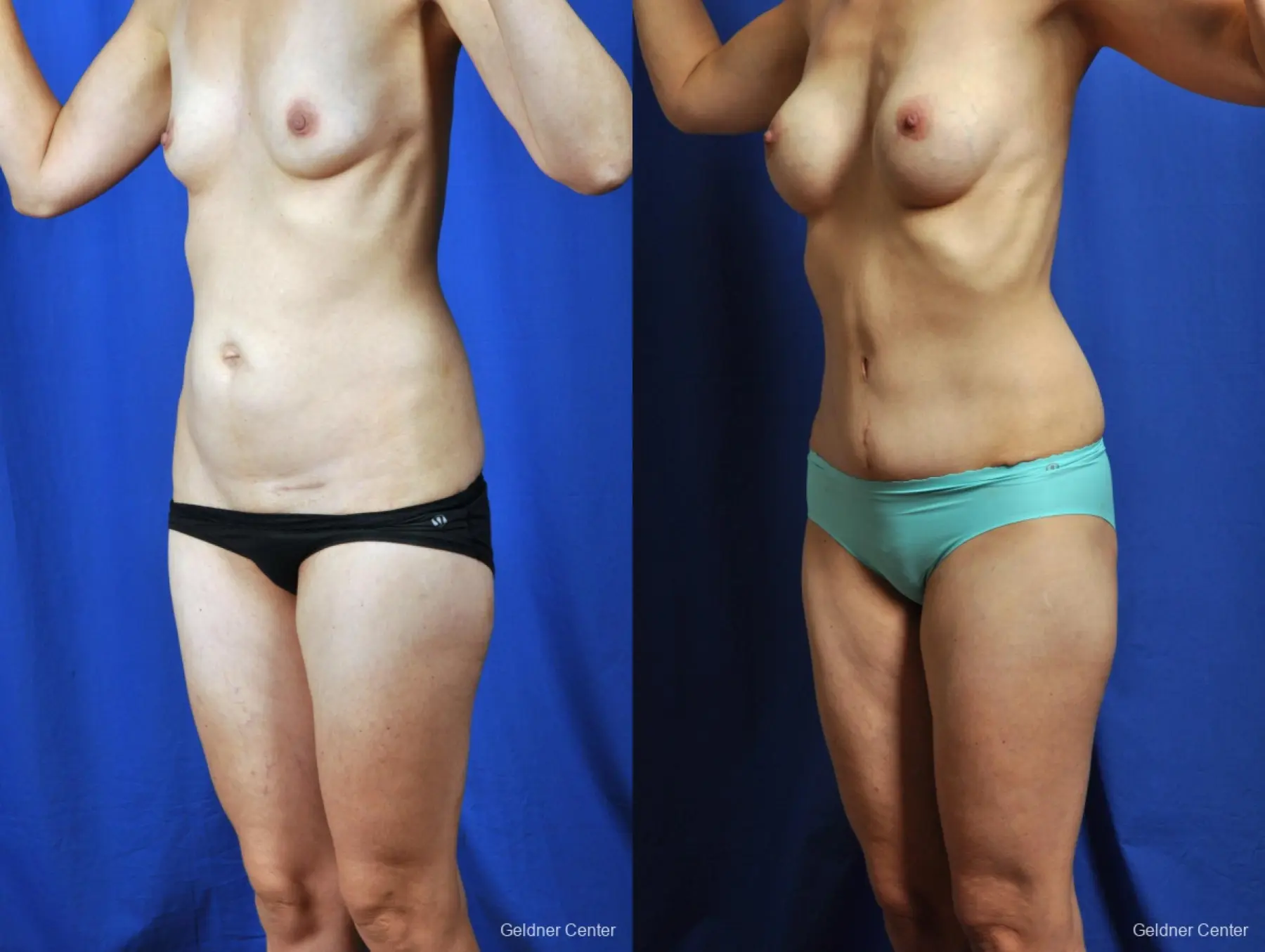Tummy Tuck: Patient 6 - Before and After 4