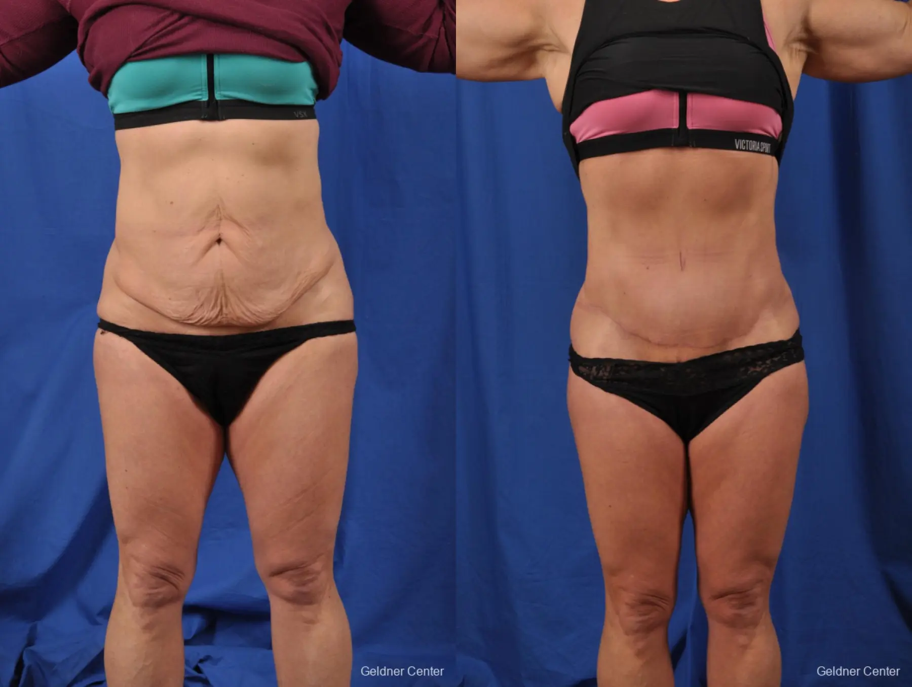 Abdominoplasty Skin Removal - Before and After
