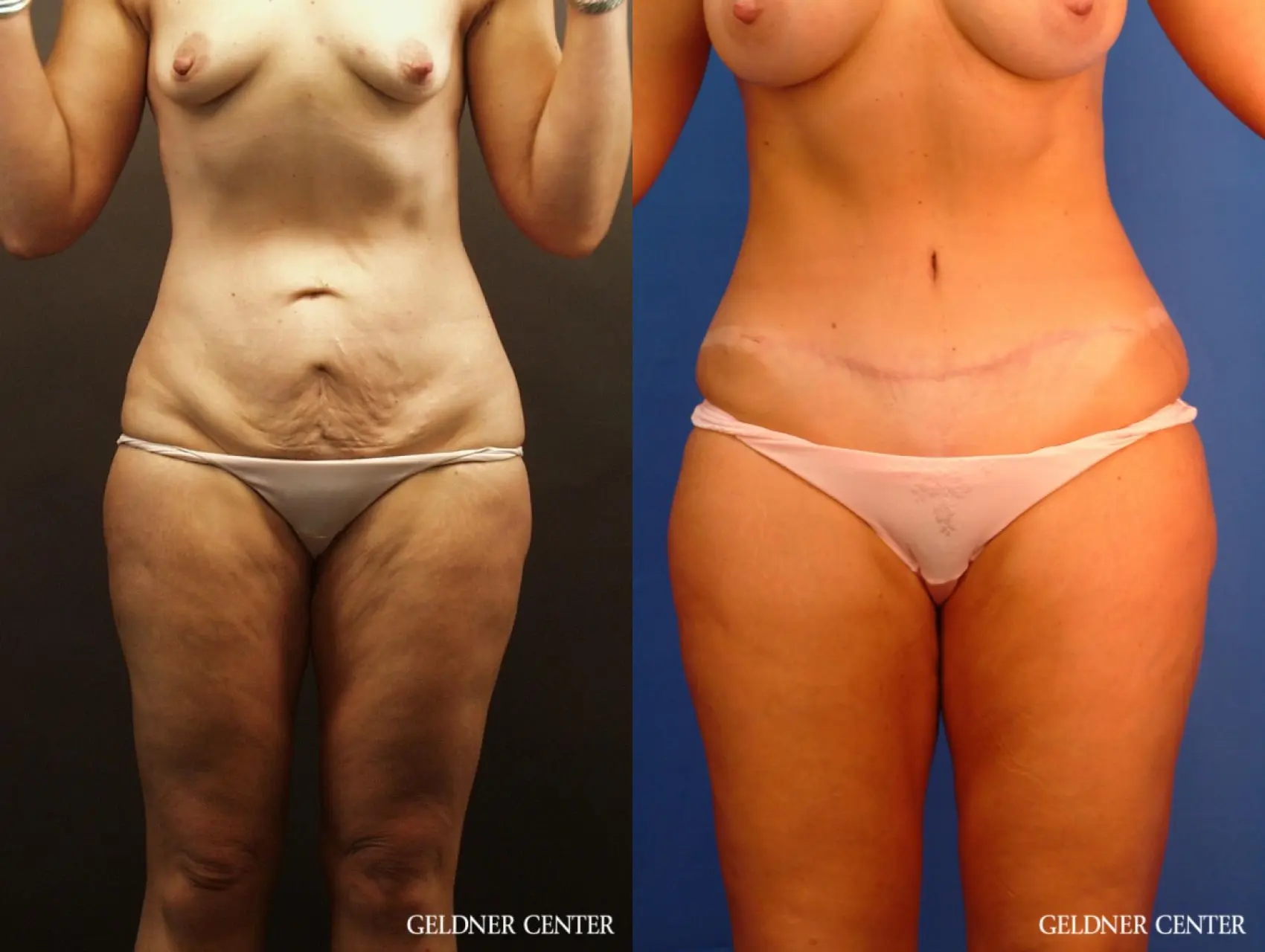 Abdominoplasty Tummy Tuck Patient 2631 - Before and After