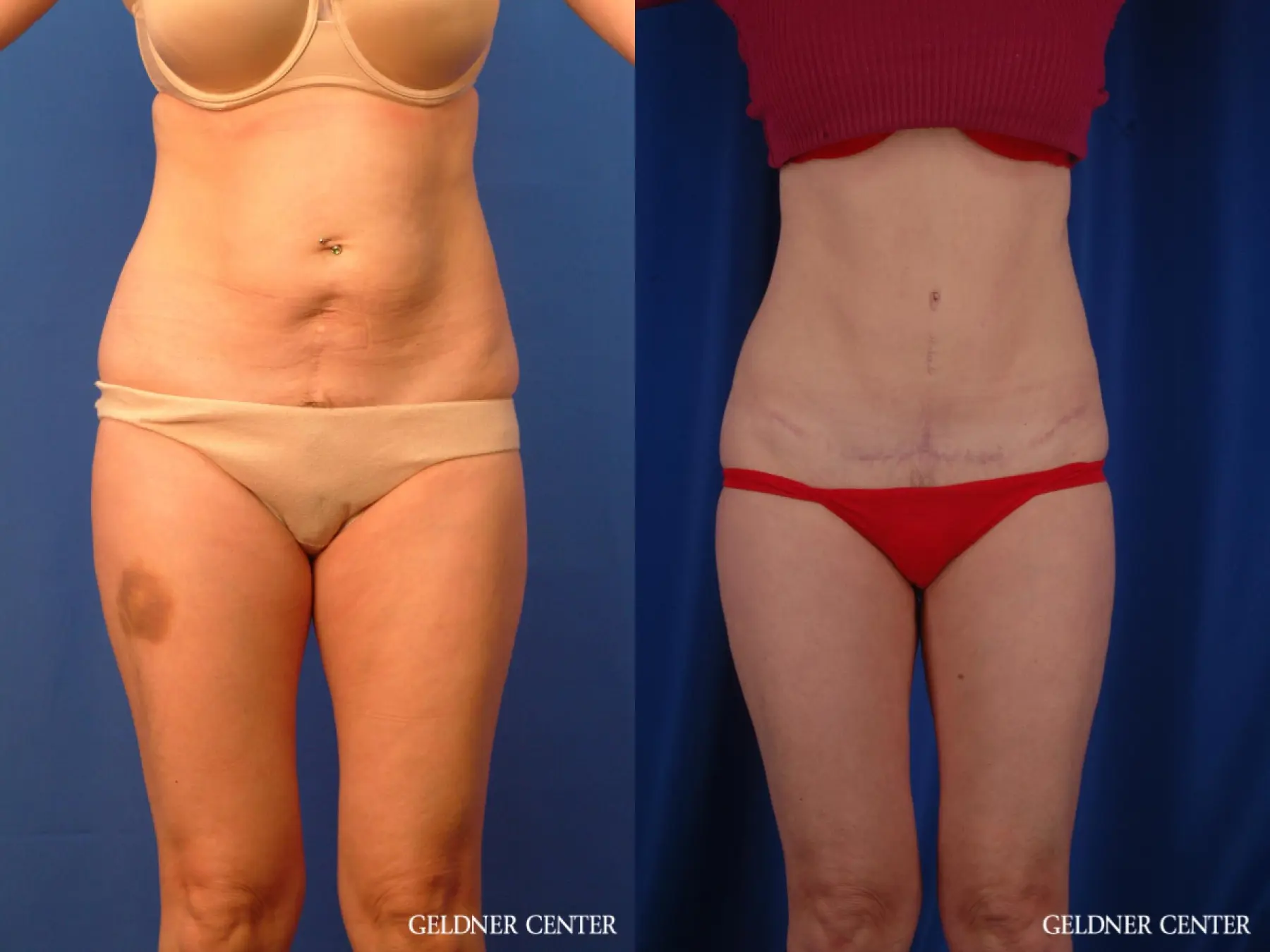 Full Abdominoplasty 6 Month Post-Op - Before and After